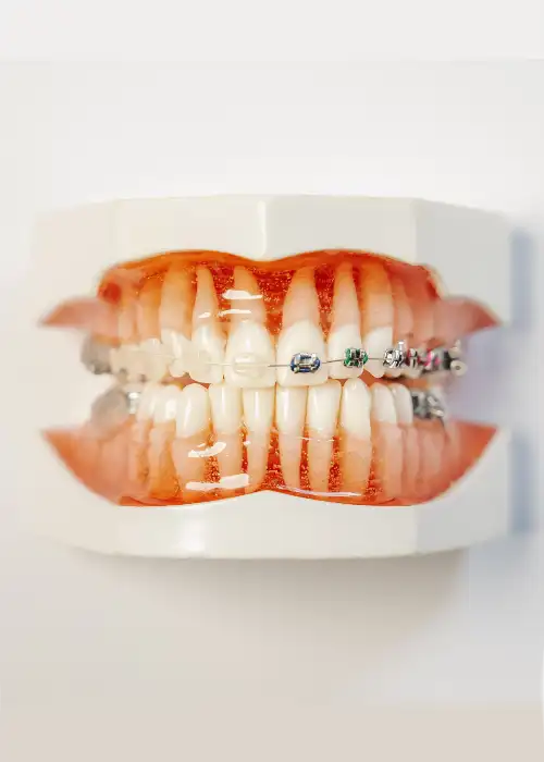 Herausnehmbare Therapiemittel: Feste Zahnspangen in verschieden Farben.