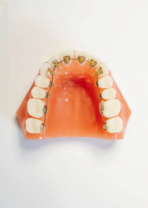 Lingualtechnik ermöglicht es Zahnspangen unsichtbar zu befestigen.